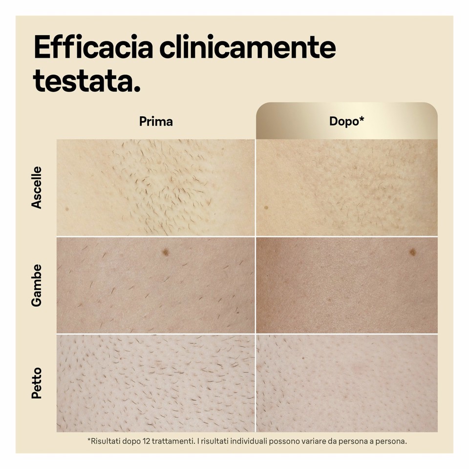 Braun Silk-expert Pro Epilatore Luce Pulsata Silk·expert Pro 5, Epilazione A Casa Tua, Con Custodia, Rasoio Donna Venus, 4 Testine, PL5356