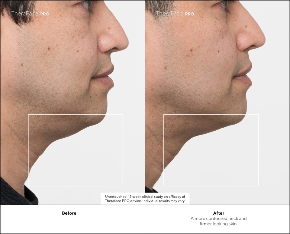 Therabody - TheraFace Pro Nero, la soluzione più avanzata per la salute del viso