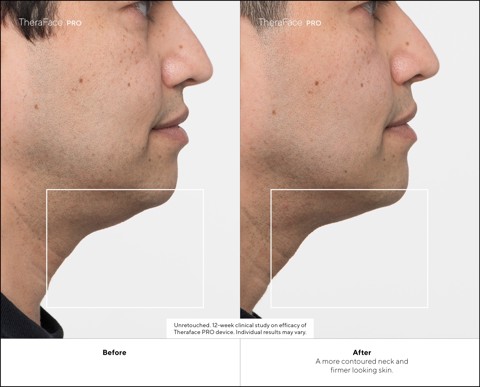 Therabody - TheraFace Pro Nero, la soluzione più avanzata per la salute del viso