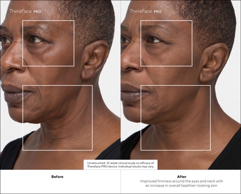 Therabody - TheraFace Pro Nero, la soluzione più avanzata per la salute del viso